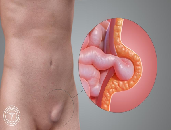 Inguinal Hernia Diagram